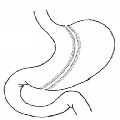 Obesity Or Bariatric Surgery