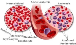 Acute Leukemia