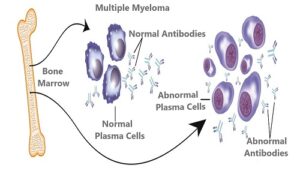 Multiple Myeloma