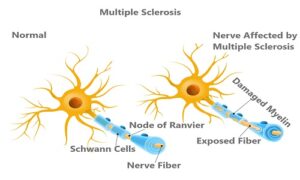 Multiple Sclerosis