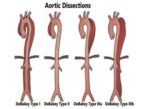Aortic Dissection