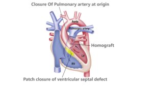 Arterial switch operation Truncus arteriosus
