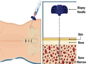 Bone Marrow Transplant