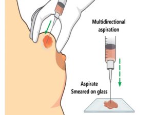 Breast Biopsy