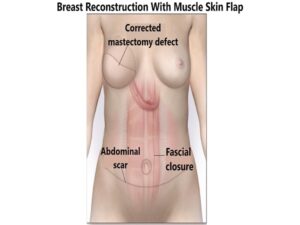 Breast Reconstruction With Muscle Skin Flap