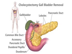Cholecystectomy Gall Bladder Removal