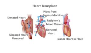 Heart Transplant