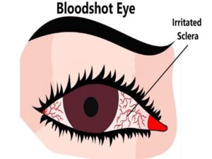 Bloodshot Eye