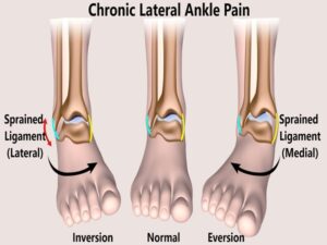 Chronic Lateral Ankle Pain