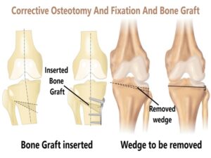 Corrective Osteotomy And Fixation And Bone Graft
