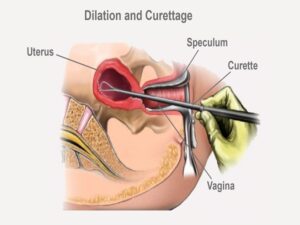 Dilation and Curettage