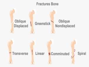 Fracture Bone Treatment