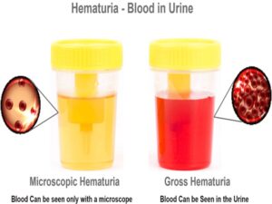 Hematuria