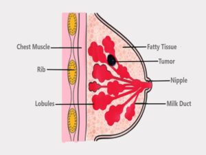 Breast Cancer Treatment in India