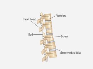 Spinal Fusion Surgery in India